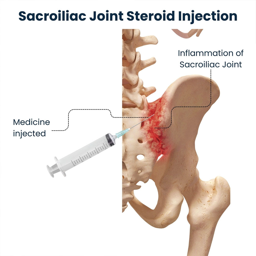 Sacroiliac Joint Steroid Injection in NYC