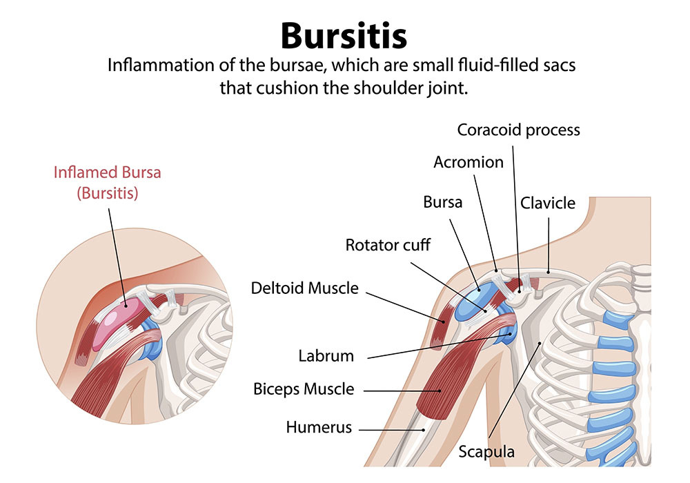 Shoulder Bursitis