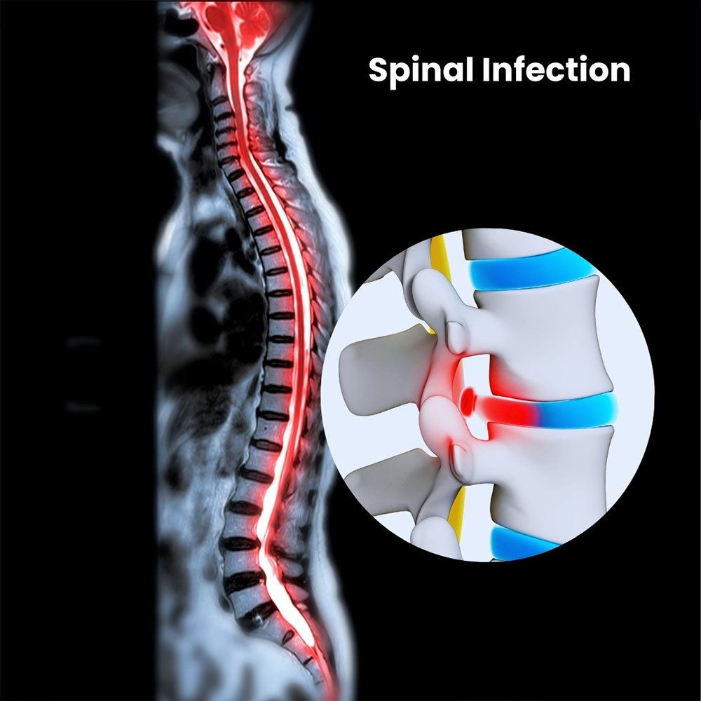 Spinal Infection Treatment in NYC