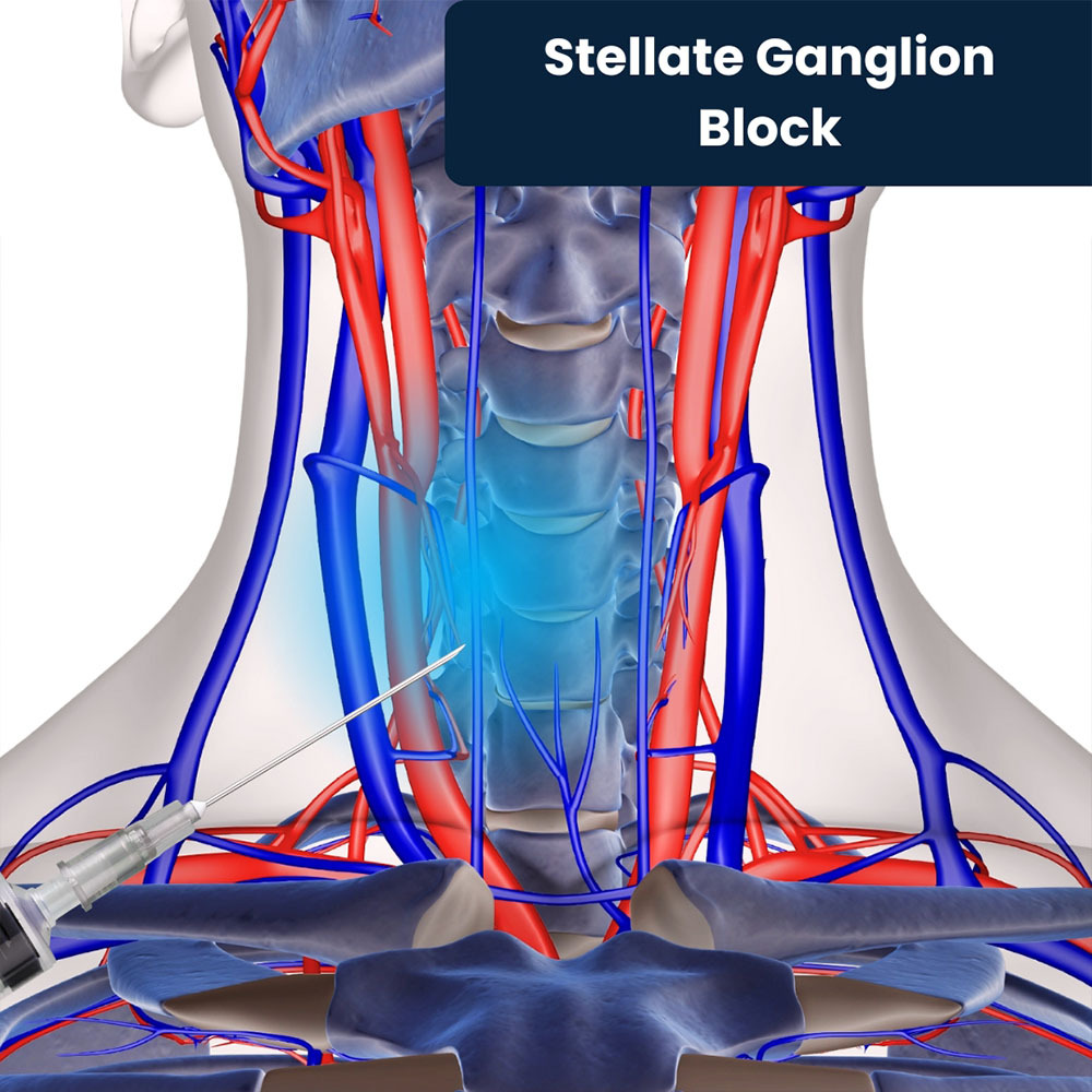 Stellate Ganglion Block