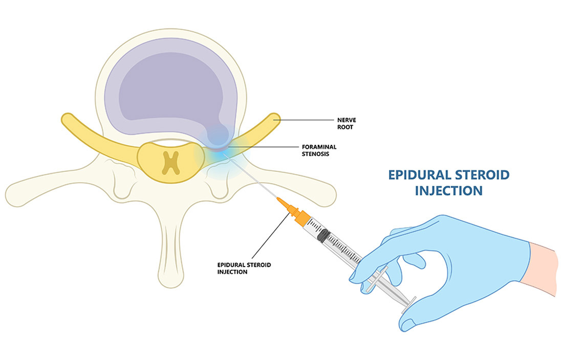 Transforaminal Epidural Injection