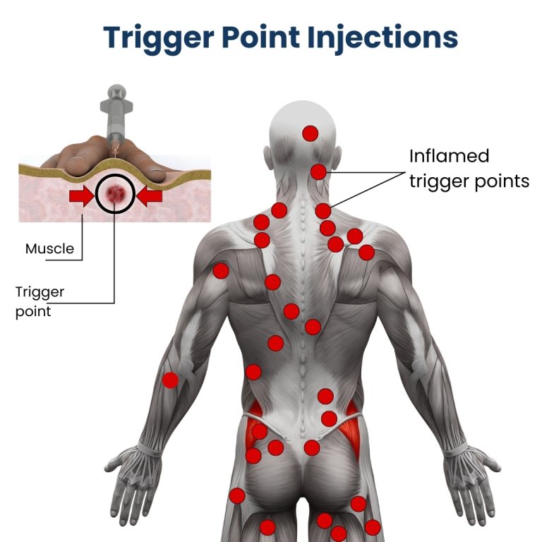Tpi Injection Neck Trigger Point Injections Specialists in NYC