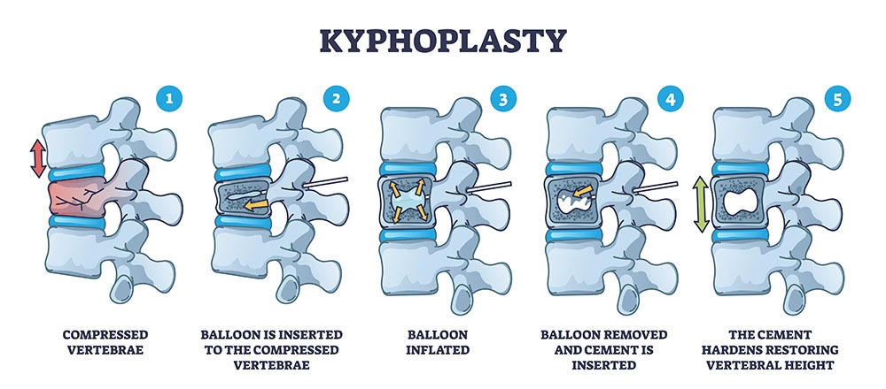 Kyphoplasty