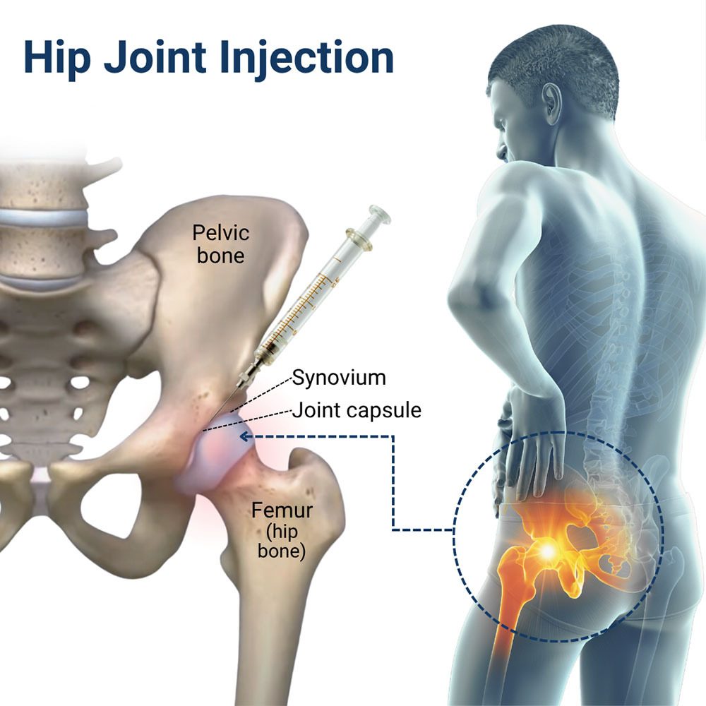 Hip Joint Injection New City, NY