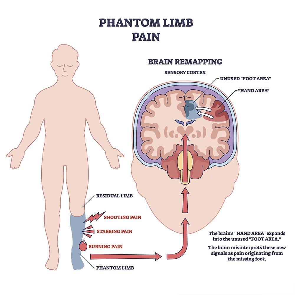 Phantom Limb Pain Treatment New City, NY