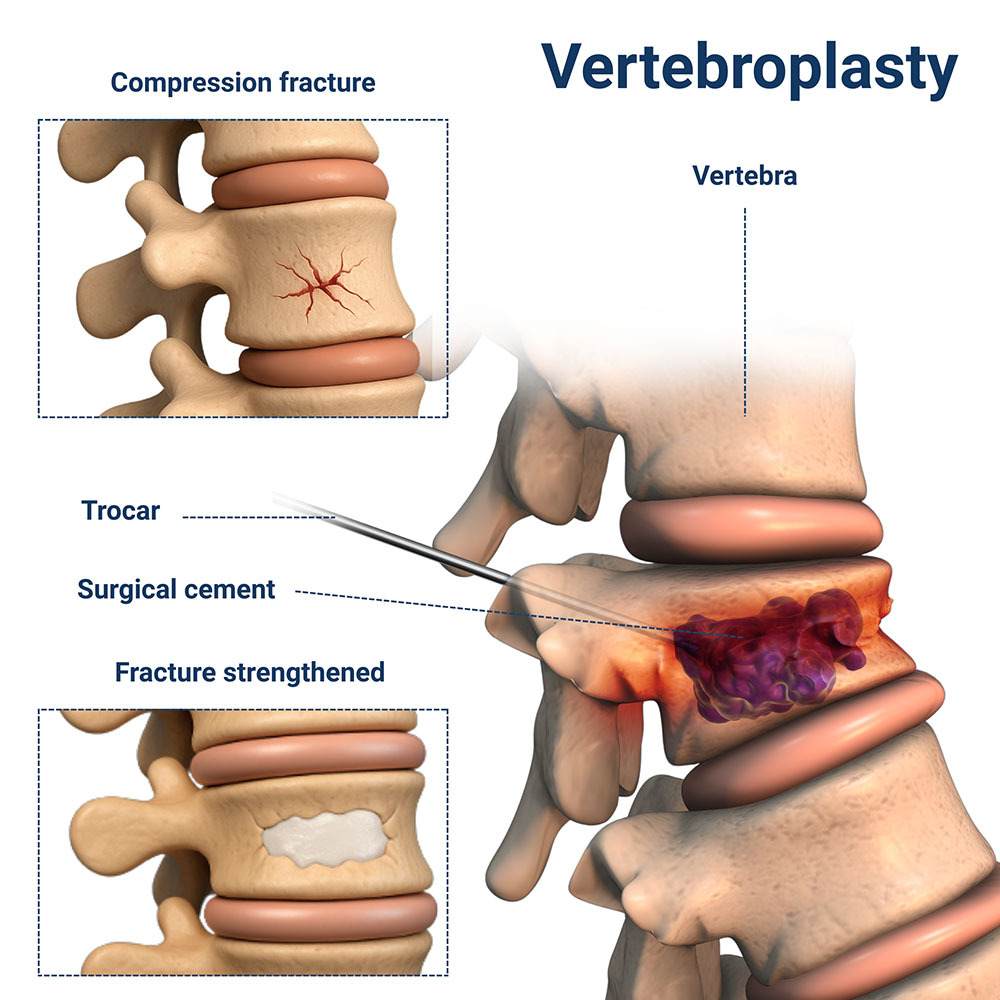 Vertebroplasty Procedure New City, NY