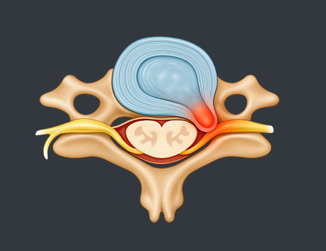 Herniated Discs Treatment NY