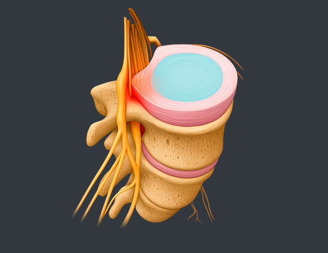 Spinal Stenosis Treatment NY